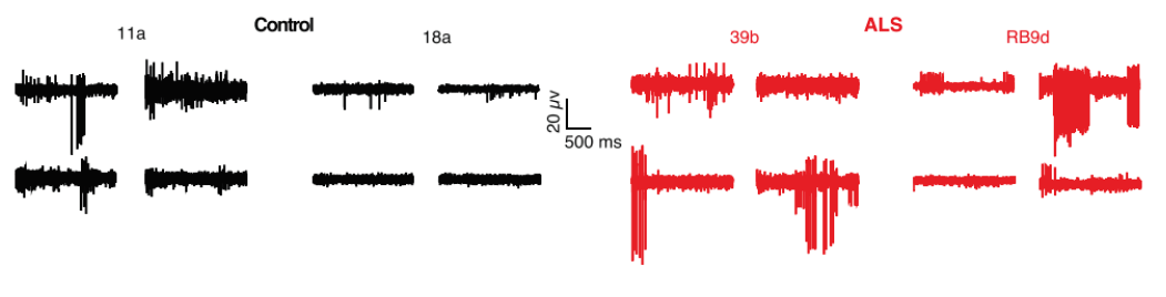 The ALS in vitro model of neurons showed responses that mirrored clinical results