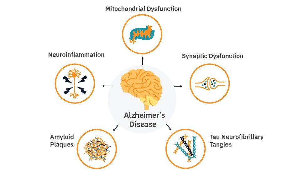 Alzheimers infographic