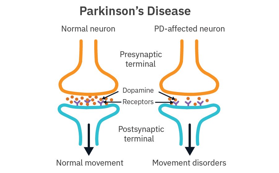 Key Characteristics of Parkinson's Progression